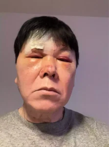 Yuji Mitsuya blessé